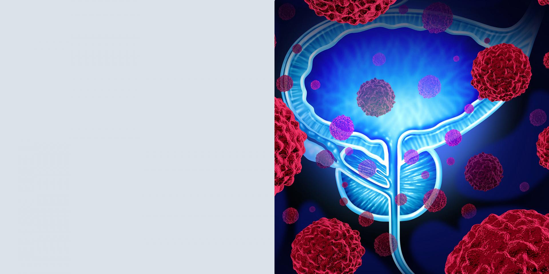 3D-Illustration der Prostata mit Krebszellen