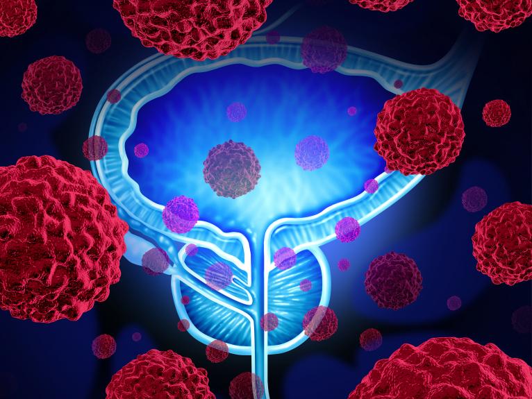 3D-Illustration der Prostata mit Krebszellen
